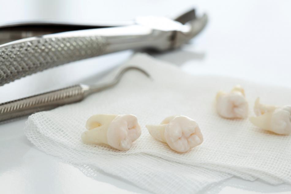 Удаление зуба: показания к операции.