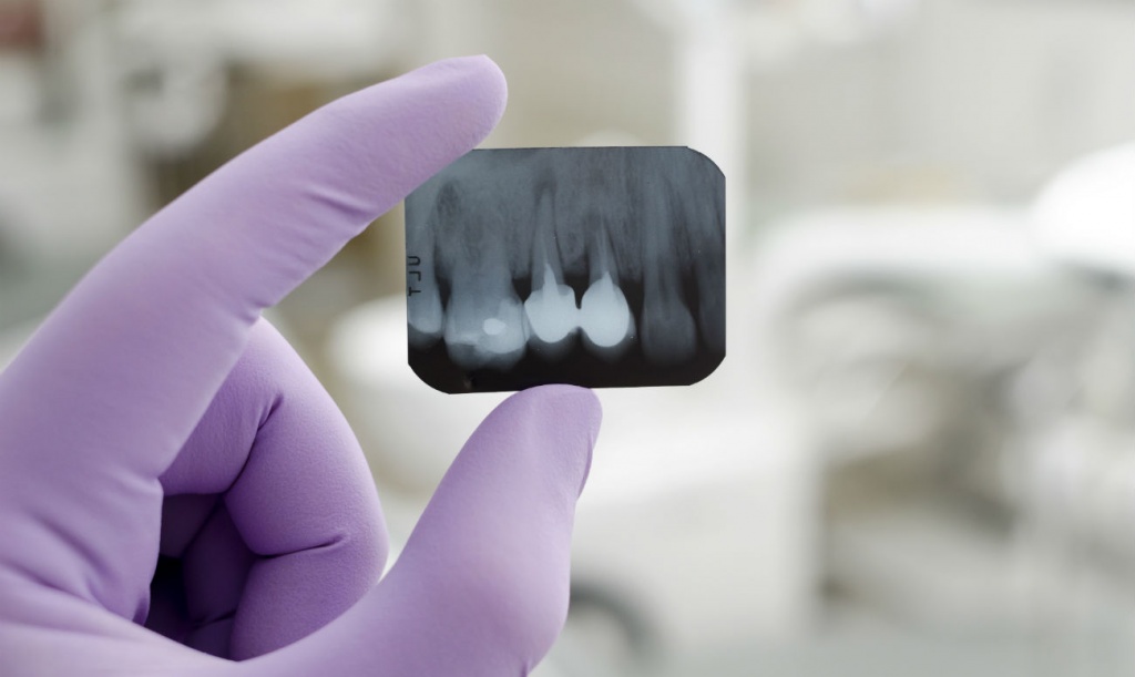 Как делают рентген зубов?