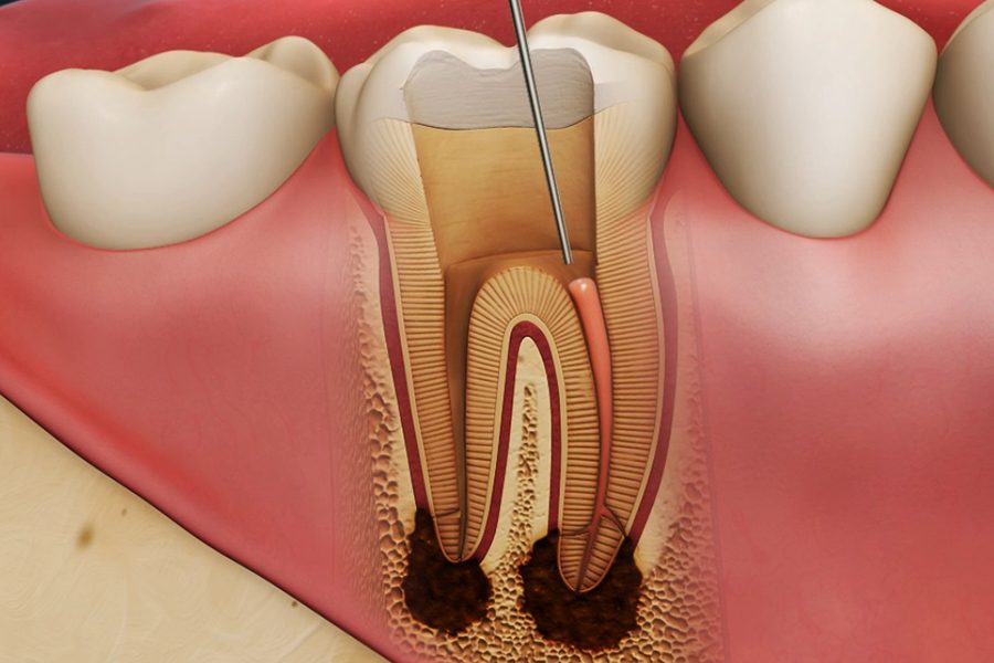 Как лечить пульпит зуба: методы и ход лечения
