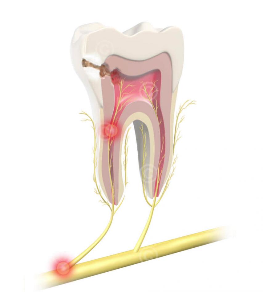 Виды болей после лечения пульпита зуба.