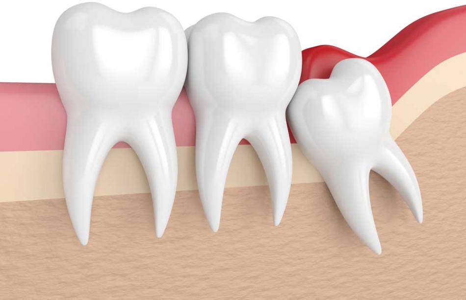 Стоит ли удалять ретинированный зуб мудрости?
