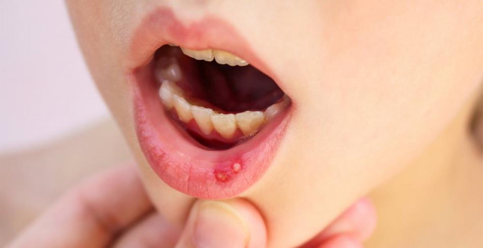 Стоматит во рту у детей: виды заболевания.