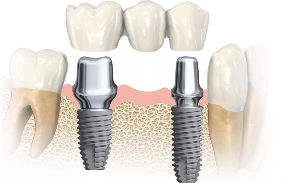 Скидки на несъемное протезирование в стоматологии.