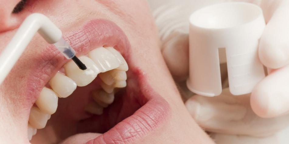 Фторирование зубов: показания к процедуре.