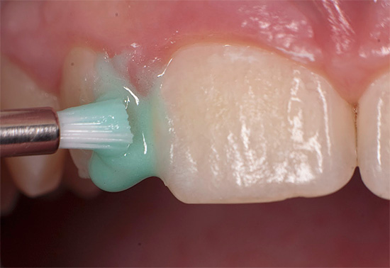 Фторирование зубов: виды и способы проведения.