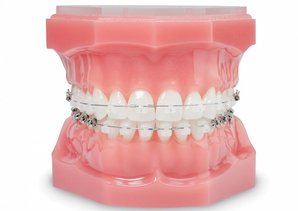 Стоимость установки безлигатурной системы на зубы.