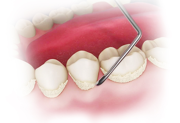 Что лечит стоматолог-пародонтолог?