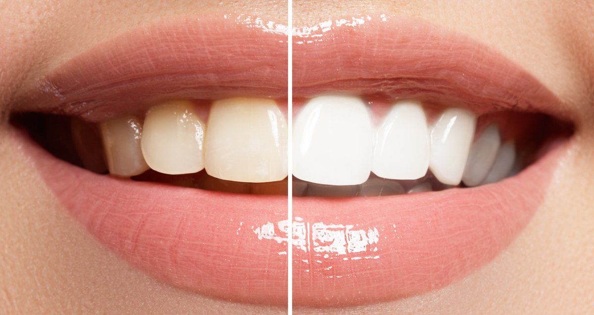 Отбеливание зубов Opalescence: сколько стоит процедура?