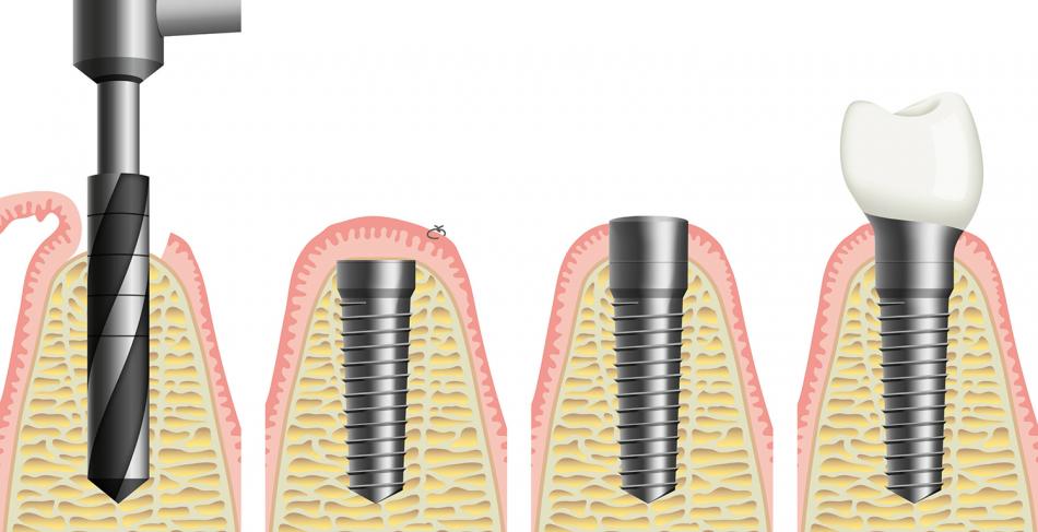этапы имплантации зубов