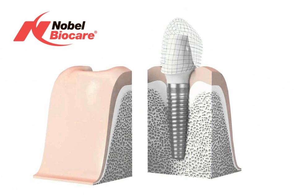Швейцарские зубные импланты Nobel: отзывы пациентов.