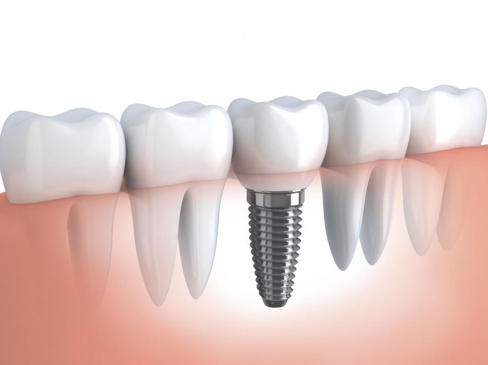 Зубные импланты Dentium