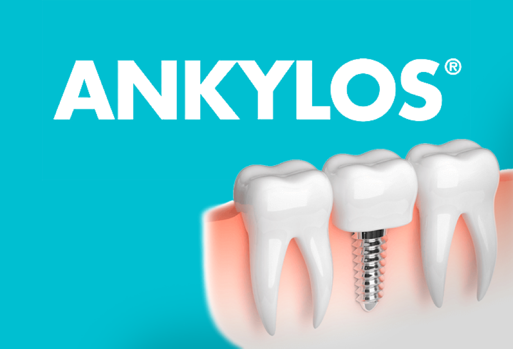 Зубные импланты Ankylos (Анкилоз): преимущества системы.