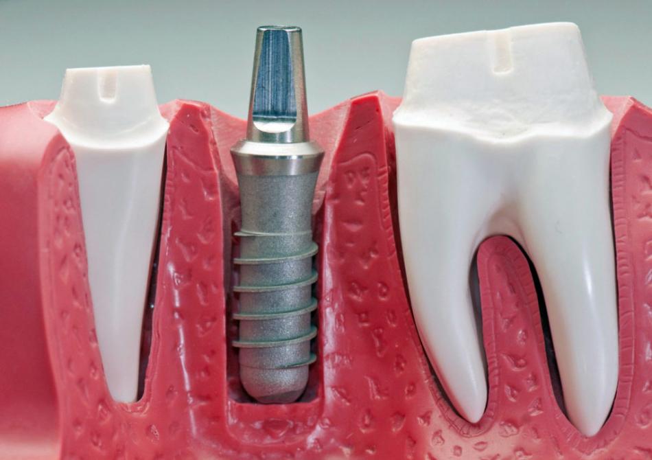 Зубные импланты ROOTT: сколько стоит установка?
