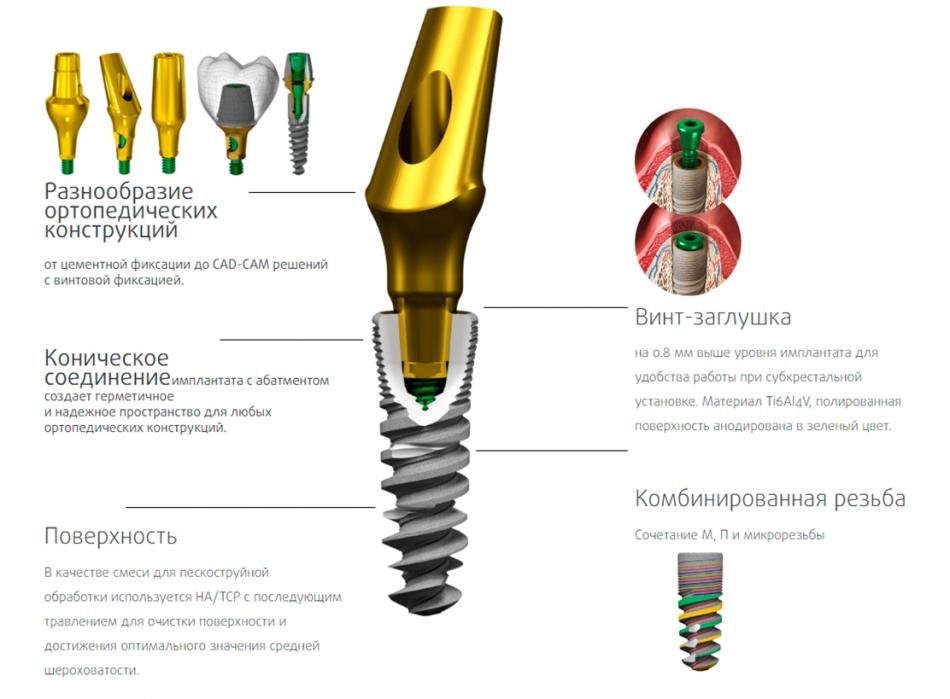 Зубные импланты ROOTT: как устанавливают?