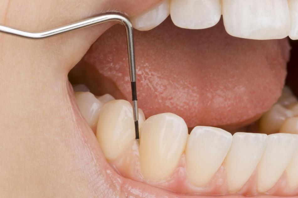 Как лечат пародонтит в стоматологии?