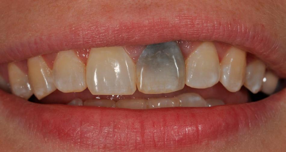 Показания к внутриканальному отбеливанию зубов.