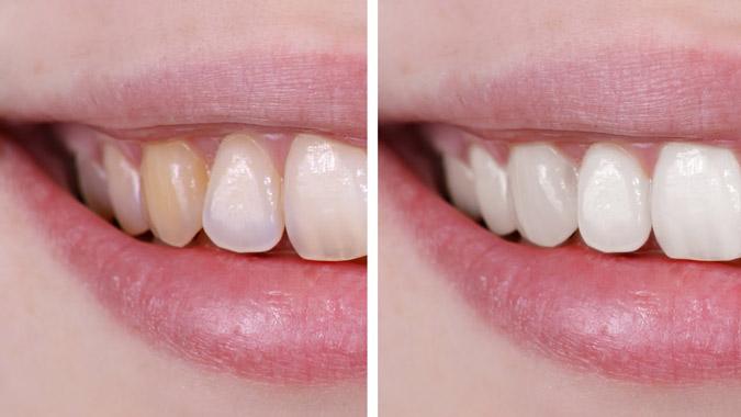 Сколько стоит эндоотбеливание в стоматологии?