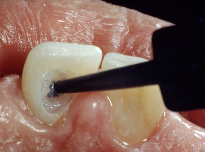 Как проходит эндоотбеливание зубов?