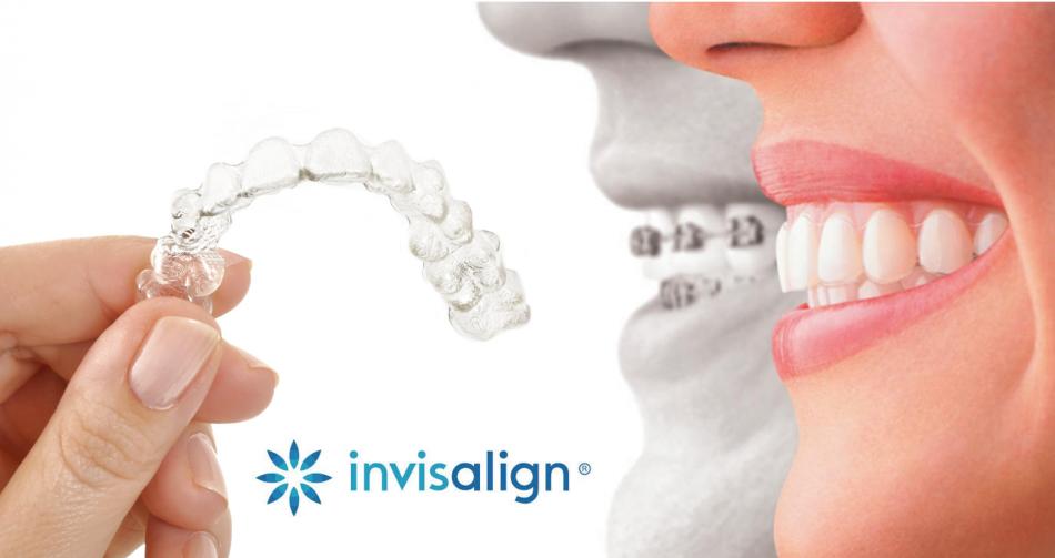 Цена на элайнеры Invisalign для выравнивания зубов.