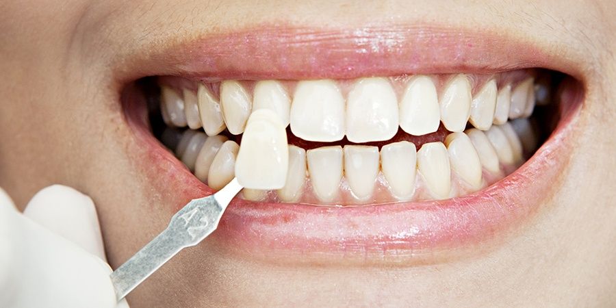 Сколько стоит установка композитных виниров на зубы?