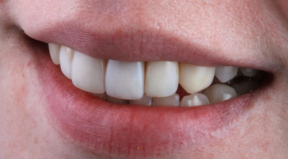 Когда устанавливают композитные виниры без обточки зуба?