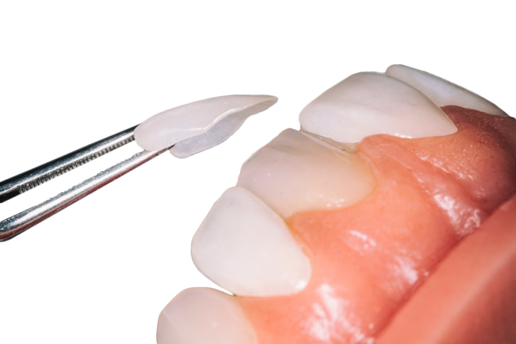 Керамические виниры на зубы: виды накладок.