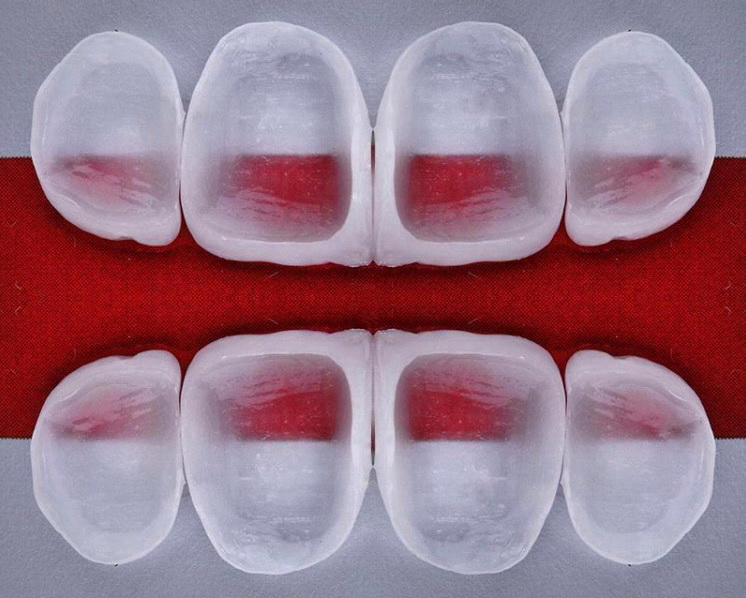 Ультраниры: показания к установке на зубы.
