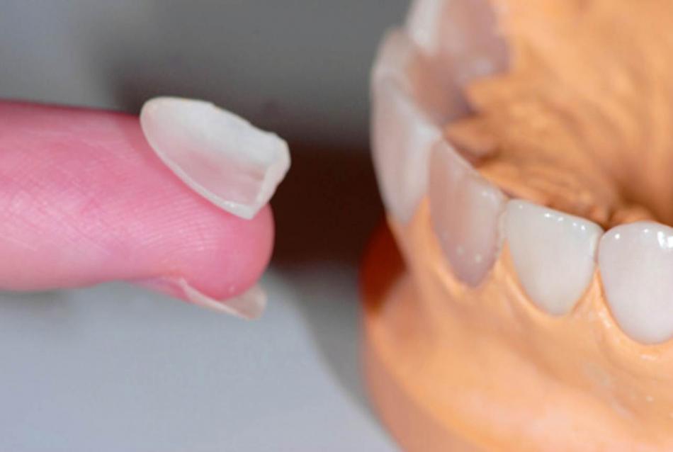 Сколько стоит ультранир на 1 зуб?