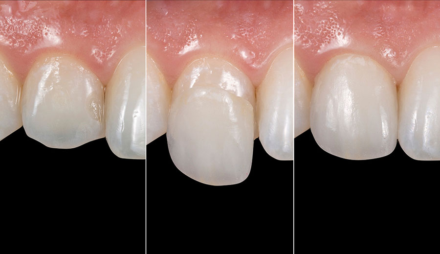 Как устанавливают ультраниры на зубы?