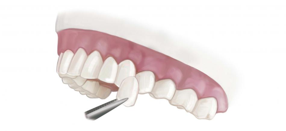 Виниры из диоксида циркония: когда устанавливают?