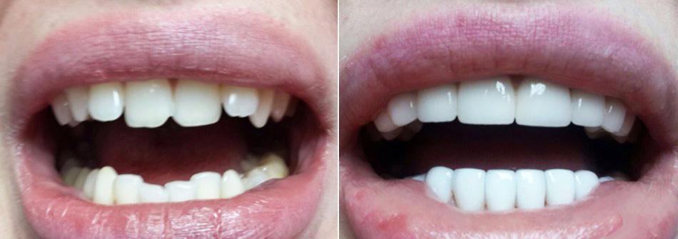 Циркониевые виниры на зубы: показания и противопоказания к установке.