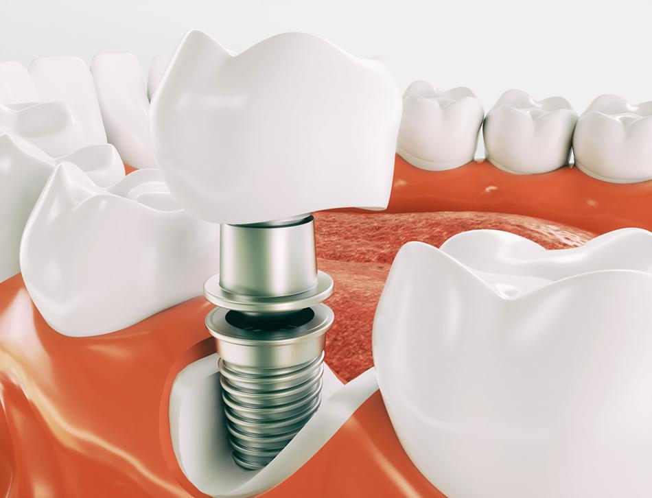 Цена на имплантацию зуба в стоматологии.