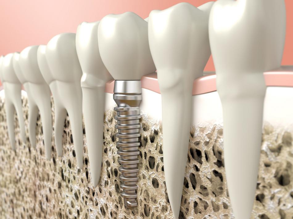 Имплантация зубов в стоматологических клиниках.