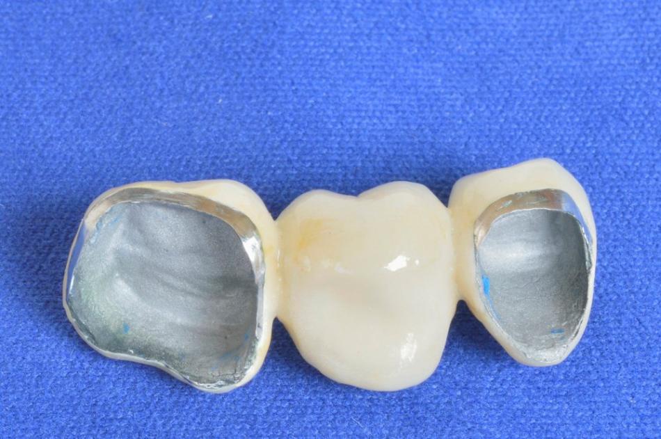 Как выбрать металлокерамику при протезировании зубов?