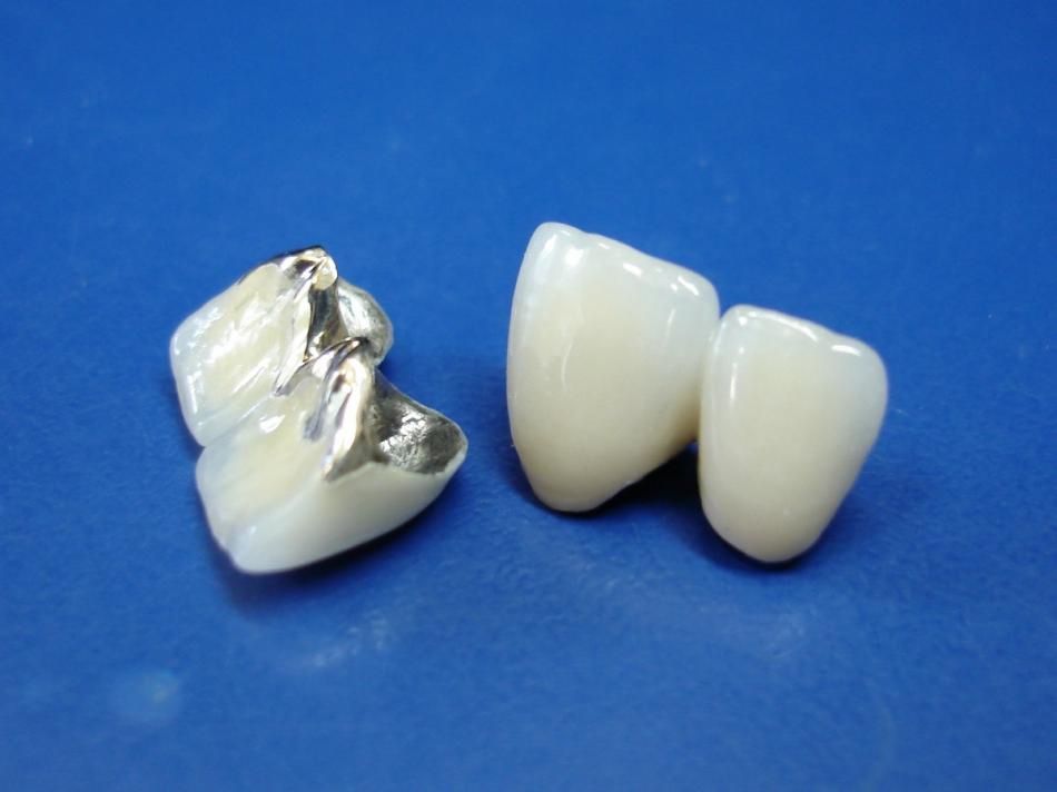 Виды металлокерамических зубных коронок.