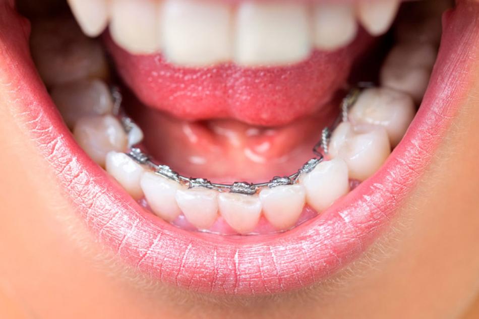 Сколько стоит поставить брекеты Win в стоматологии?