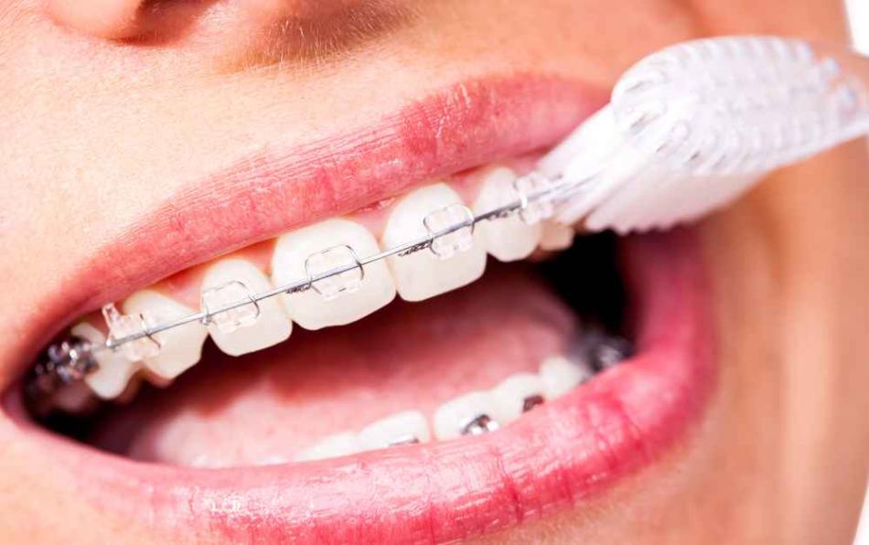 Как устанавливают керамические брекеты Clarity на зубы?