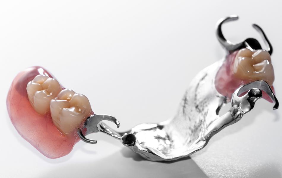 Как фиксируют бюгельные протезы на зубы?
