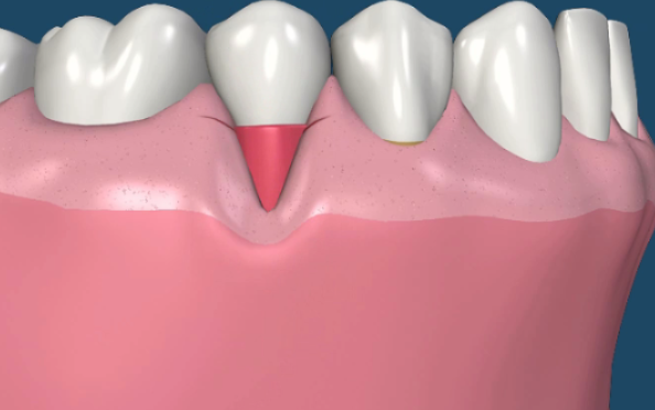 Гимисекция в области одного зуба