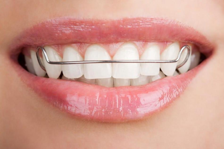 Установка ретейнеров на зубы в стоматологии.