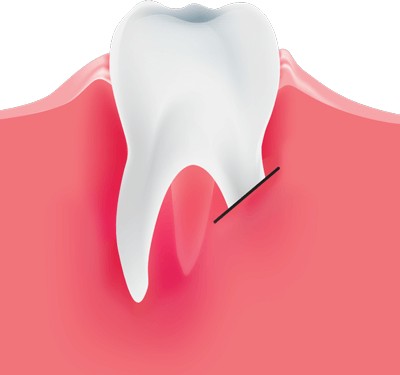 Гемисекция корня зуба: как делают операцию.