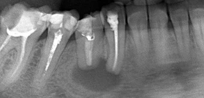 Гемисекция корня зуба: показания к операции.