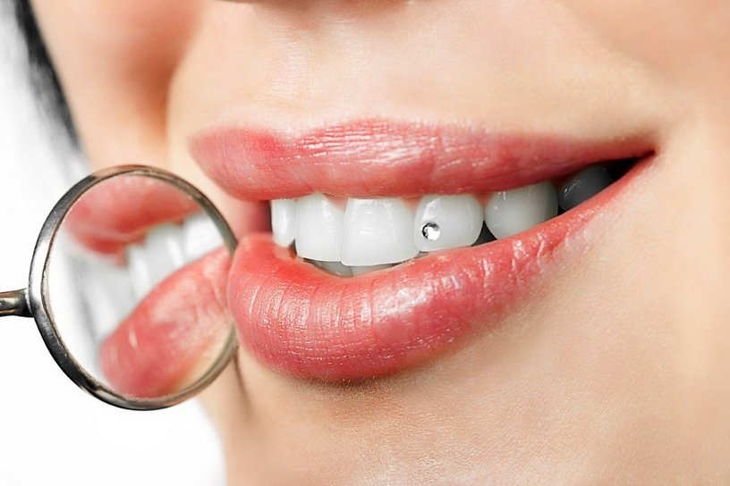 Как ставят скайсы на зубы в стоматологии?