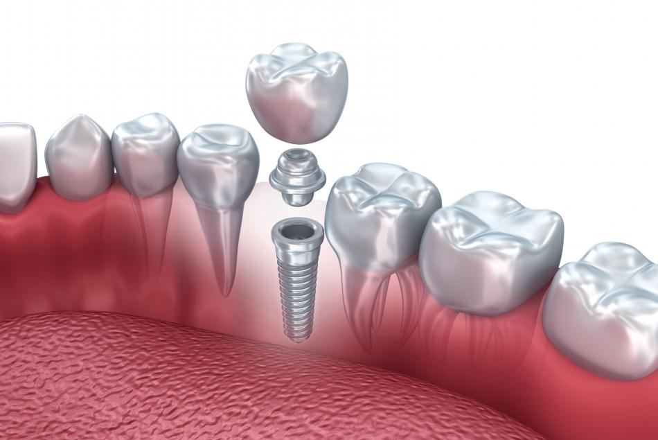 AB Dental Devices: отзывы на имплантаты