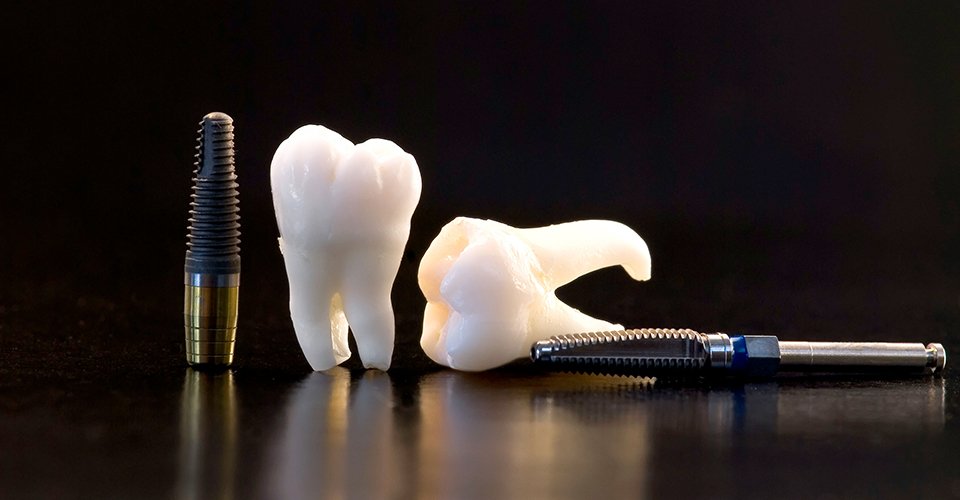 Особенности зубных американских имплантов.