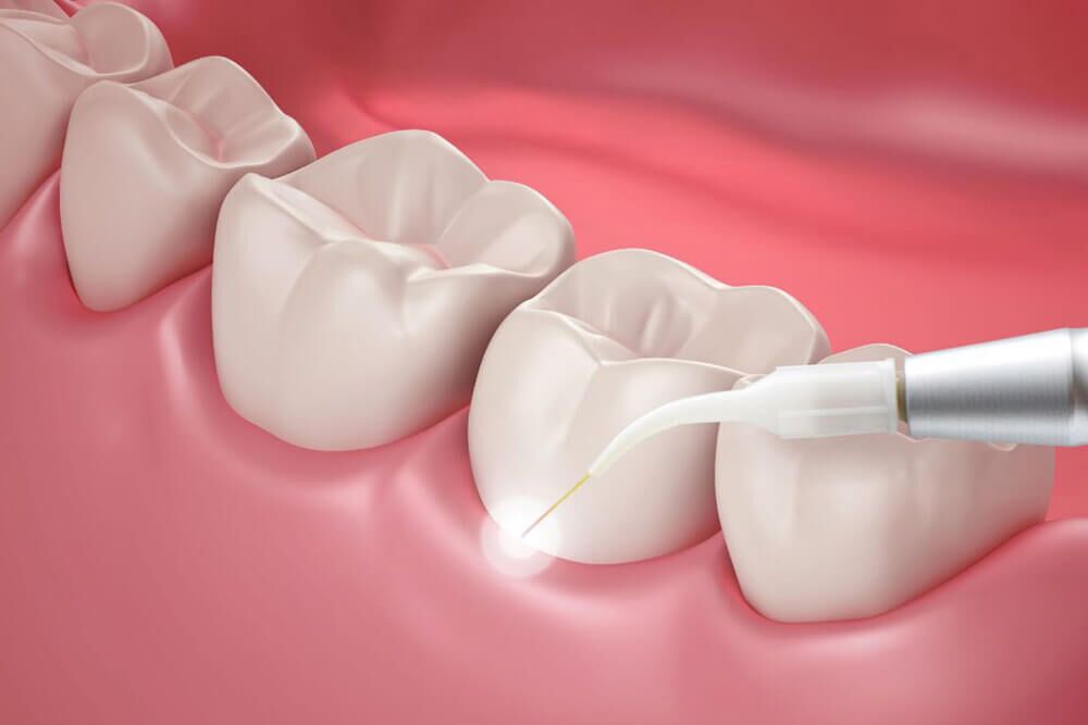 Когда делают гингивэктомию в стоматологии?