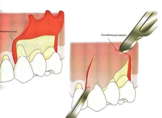 Гингивэктомия: методы операции.