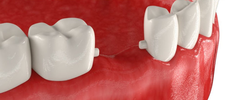 Адгезивный мостовидный протез в стоматологии