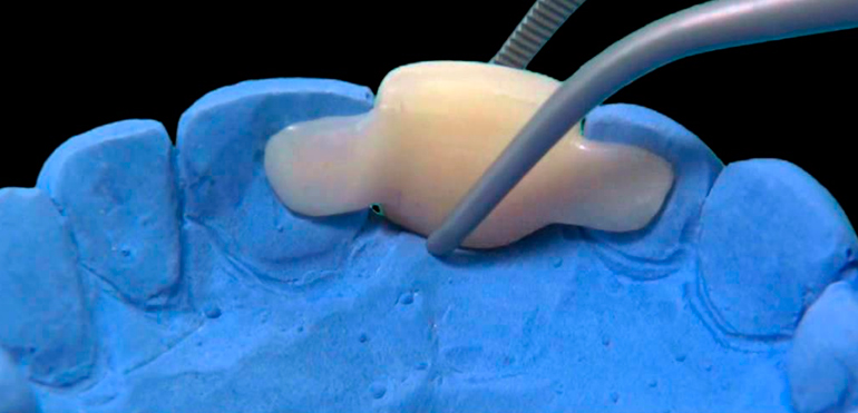Стоматологический адгезивный зубной мост