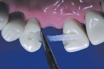 Насколько зубов ставят адгезивный мост?